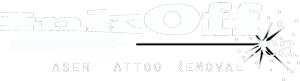 InkOff Laser Tattoo Removal